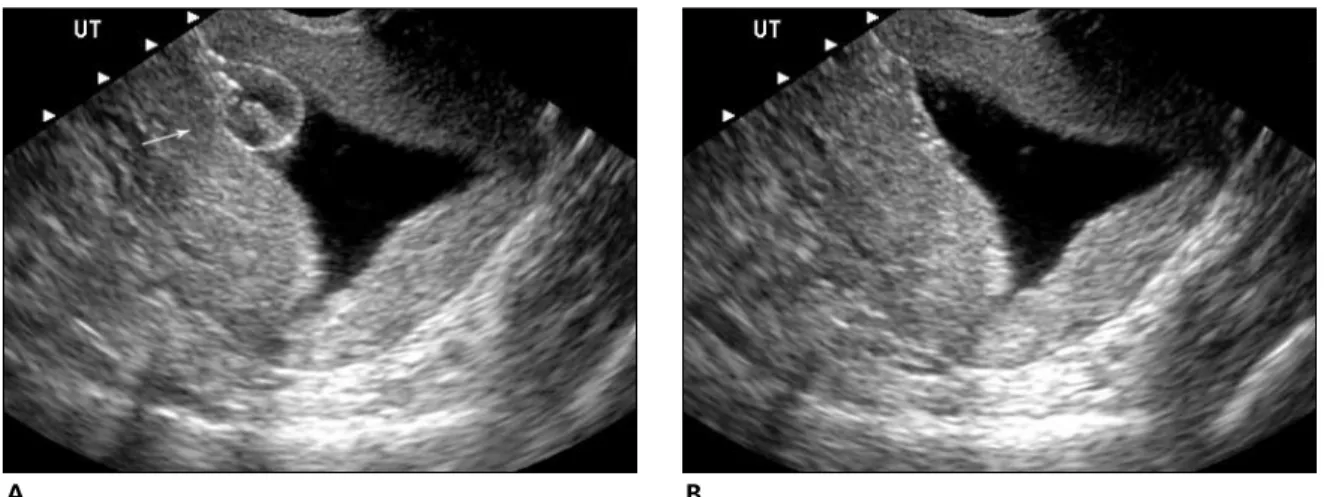 Figure 5. Normal saline infusion sonohysterogram. The endometrial cavity is well distended, and the endometrial lining is thin, delicate, and uniform in echo texture