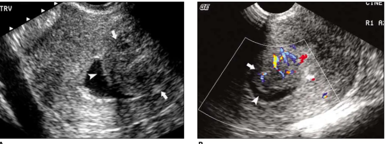 Figure 9. Submucosal fibroid in a 54-year-old woman with postmenopausal bleeding. Saline infusion sonohysterography shows a hypoechoic mass (arrows) with an echogenic endometrium (arrowhead) draped over it