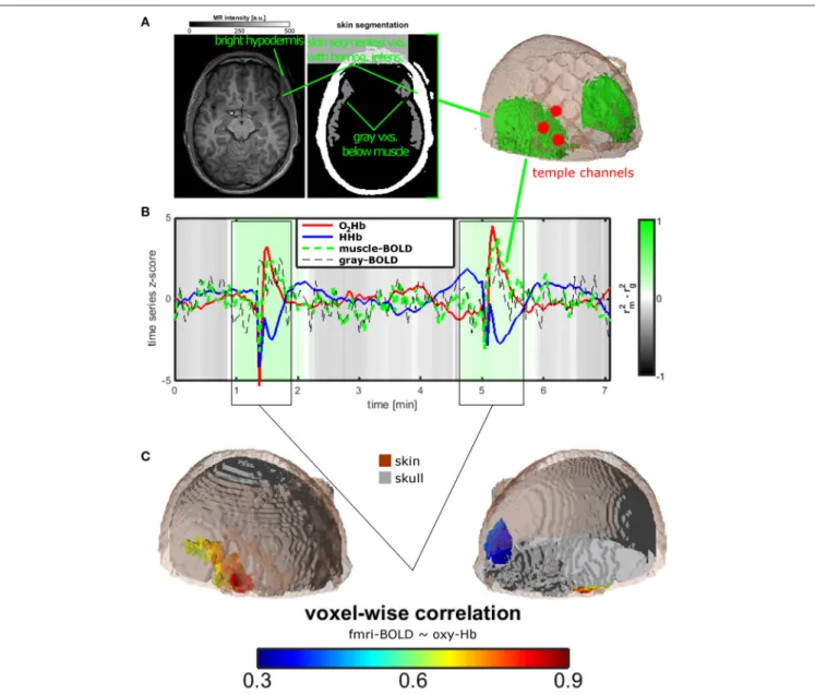 FIGURE 2 | Measurement setup and findings for experiment 2. (A) Temporal muscle extraction of one healthy subject and three fNIRS channels covering the edge of the temporal muscle