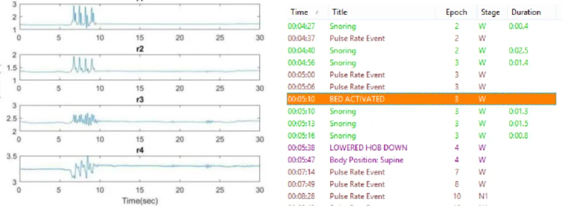 Figure 9. Tapping motion in bed sensor signal and corresponding annotation 