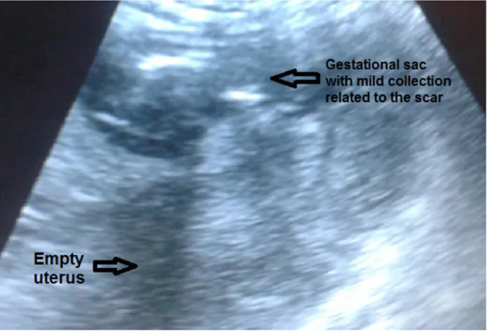 Figure 1: Abdominal ultrasound shows empty uterus, mild collection and fetus in  front of the anterior uterine wall at the site of scar 