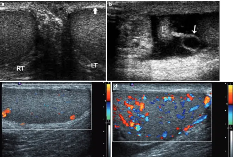Figure 1. a–d. Normal anatomy and techniques. A 35-year-old man with transverse gray-scale US image of both testes (a) through the median  raphe of the scrotum in order to compare the echogenicity of the testes on a single image