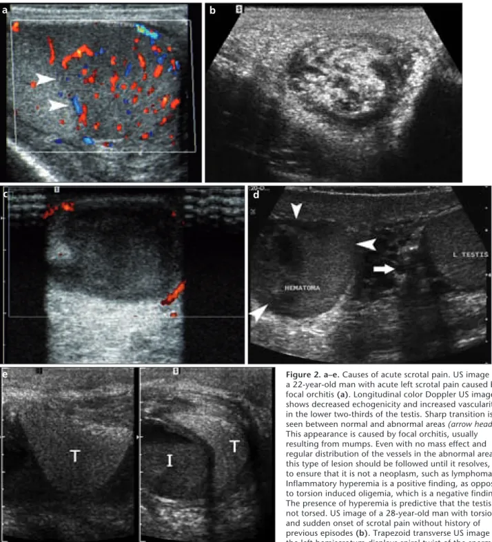 Figure 2. a–e. Causes of acute scrotal pain. US image of  a 22-year-old man with acute left scrotal pain caused by  focal orchitis (a)