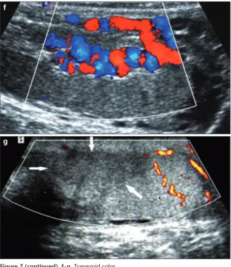 Figure 8. a, b. Microlithiasis. A 26-year-old man  with microlithiasis, seeking treatment for infertility  after 1.5 years of normal sexual intercourse (a)