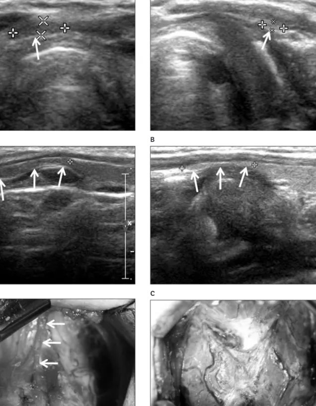 Figure 1. True-positive case: 38-year-old man with a right pyramidal lobe detected on thyroid sonography and at surgery