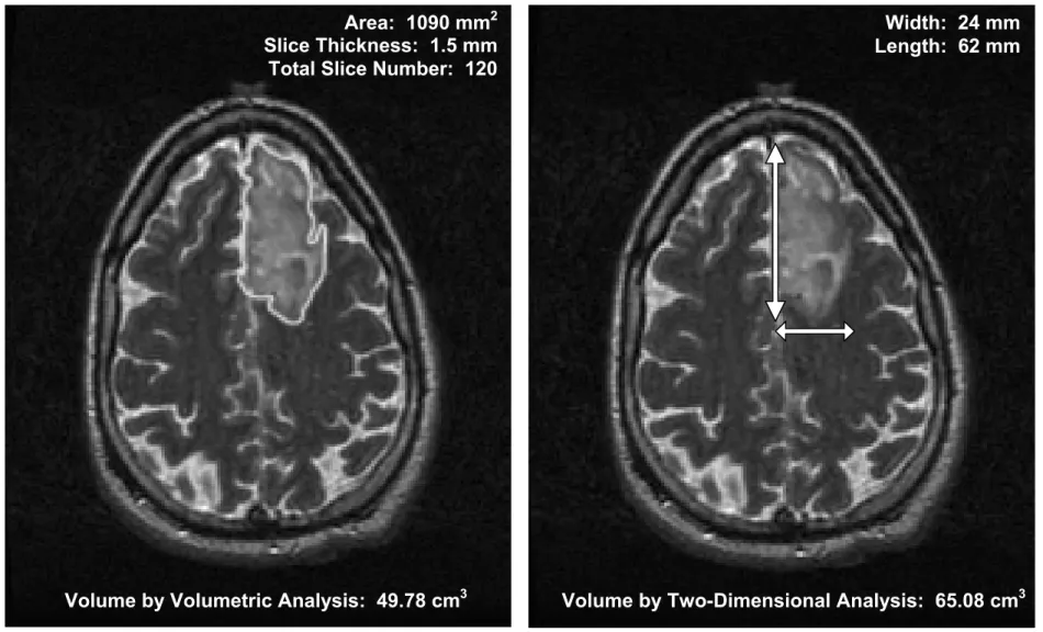 Figure 2:  Volumetric vs. Two-Dimensional Postoperative MRI Analysis 