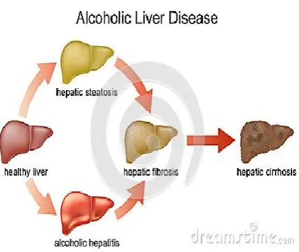 Figure 1. Disease due to alcohol Consumption 