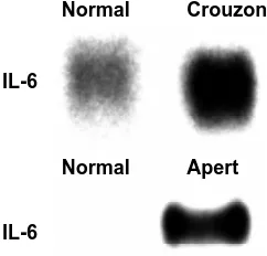 Fig. 2. Expression of FGF 2 mRNA in human normal and Crouzonosteoblasts in the presence (+) or absence (-) of FGF 2