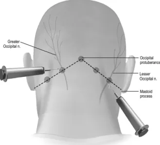FIG. 1. Greater and lesser occipital nerve blocks. Reproduced with permission from Oxford University Press