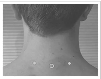 Fig 1.—The lower cervical injections are performed in the paraspinous muscles bilateral to the C6 or C7 spinous process.
