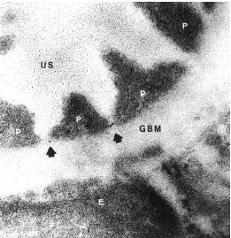 Fig. 5. Immunoelectron microscopic localization of nephrin in humanrenal glomeruli.ity purified IgG against the extracellular region of recombinant humannephrin and 10 nm gold -coupled secondary antibody