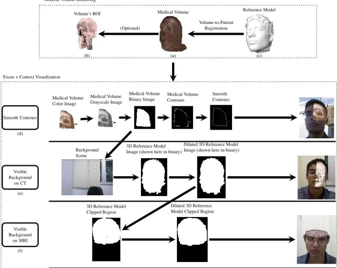 Fig. 2. Overview of the proposed on-patient visualization solution: Medical volume is rendered and, based on the 3D reference model reconstructed previously, the volume data can be positioned into the augmented scene