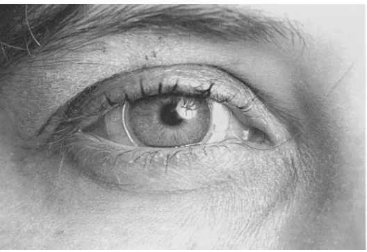 Figure 2.4: Scleral search coil