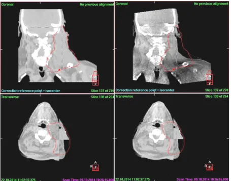 Fig. 5. Tumour shrinkage as observed with kVCBCT.