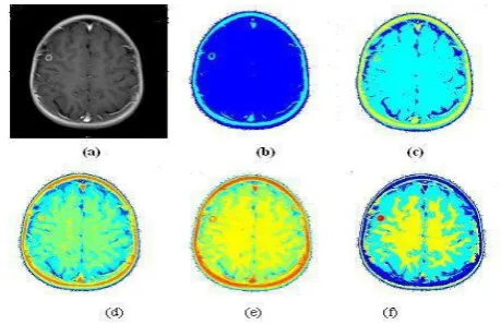 Figure 1.4 (a) Enhanced T2 weighted MRI brain tumor image, (b-e) is segmented image using wavelet based GA algorithm with NC=2,3,6,9 (Number of cluster) and (f) is a resultant segmented image with four cluster (white matter, gray matter, CSF and tumor(red)