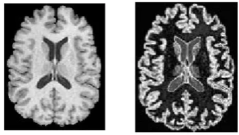 Figure 1.Original MRI imageFigure 2. Image after Cluster 1 