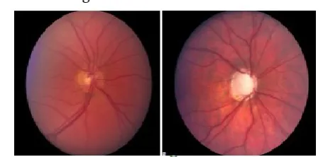 Figure 1. Healthy Fundus Image and Glaucoma Affected Fundus Image with Damaged Optic Nerve 