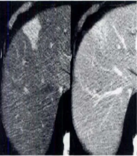Figure 9. A False Positive Liver Lesion Shown on the CT Arterial Phase  in a female of 60 Years and Its Correction on MRI 