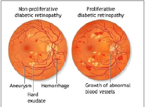 Figure 1: Diabetic Retinopathy Various Fields  