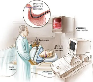 Figure 7: schematic drawing of an EUS consultation,     source: http://www.thaimed.us/what-is-endoscopic-ultrasound-eus/2008/04/24/ 