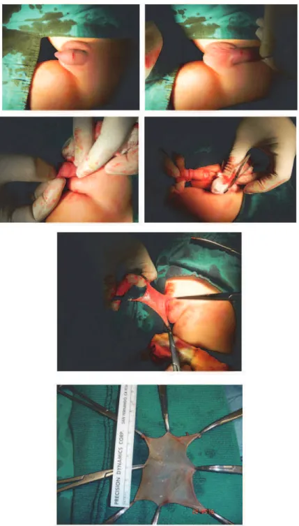 Fig. 1. Circumcision and preparation of skin graft 