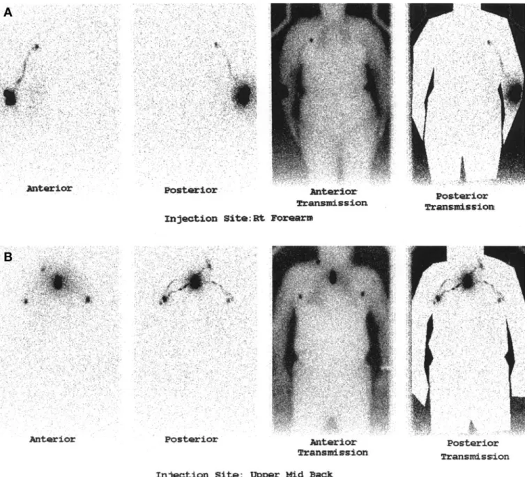 FIGURE 4. (A) Images obtained when injection site was right forearm show continuous lymphatic vessel and inferior axillary node but no olecranon node