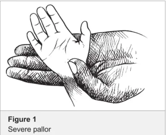 Figure 1 Severe pallor
