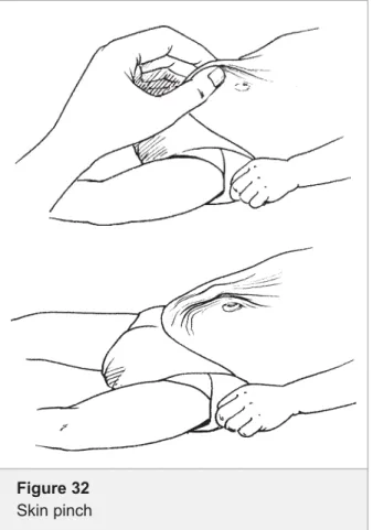 Figure 32 Skin pinch