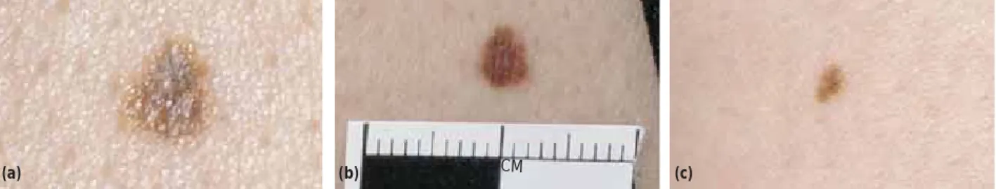 Fig 1. Junctional moles: these are normal moles which develop from early childhood. They are normally less than 5 mm in diameter.