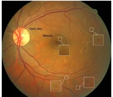 Figure 2. An example of a fundus image showing signs of DR. MAs are zoomed. 