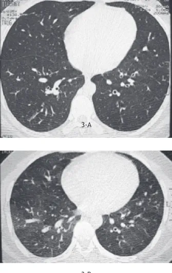Figure 3: 35 y, F, ILD, on inspiratory images (A), homogeneous  attenuation  together  with  interstitial  thickening  is  seen  whereas  on  expiratory  images  (B)  subsegmental  air  trapping  is seen.