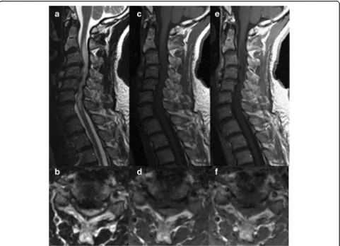 Fig. 2 MRI images of a 67-year-old man with spinal cord edema due to cervical spondylosis revealing T2 high (a, b), T1 iso (c, d) signal intensity,and negative gadolinium enhancement (e, f)