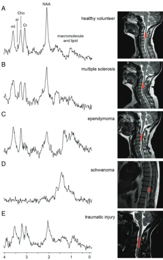 FIG 3. In contrast to controls,spinal cord show a distinct change in the metabolite ﬁngerprint, with high correlation to con-natural MR spectroscopy acquisitions in the brain