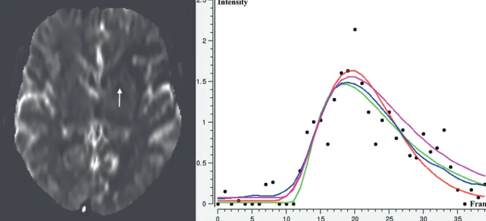 FIG 2. Selected section from a DWI dataset with a corresponding DWI lesion (black) and overlaidtissue-at-risk volumes for delay thresholds between 2 and 12 seconds calculated by using the 10different TTP/Tmax estimation methods.
