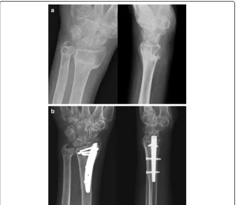 Fig. 1 A 63-year-old female patient with distal radius fracture of 16 weeks.projections