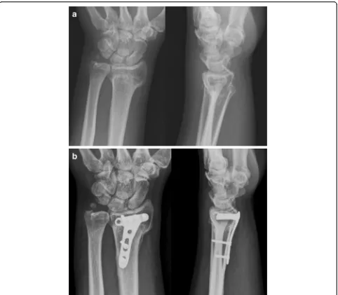 Fig. 2 A 39-year-old male patient with a distal radius fracture of 28 weeks. a Preoperative radiographs showing malunion, posteroanterior, andlateral projections
