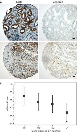 Figure 5 .   Association between apoptotic rate and fatty acid synthase (FASN) expression in human prostate cancer
