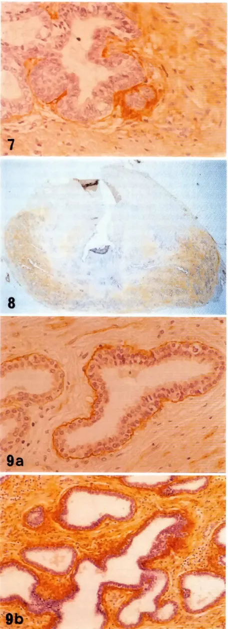 Fig. 9. Immunolocalizationof tenascinold subject.x200.in the prostatefrom a 16-year-(a) Inner zone showsweak, heterogeneousimmunostaining (b) Peripheral zone reveals diffuseimmunostainingin the stromawith intenseperiglandular area