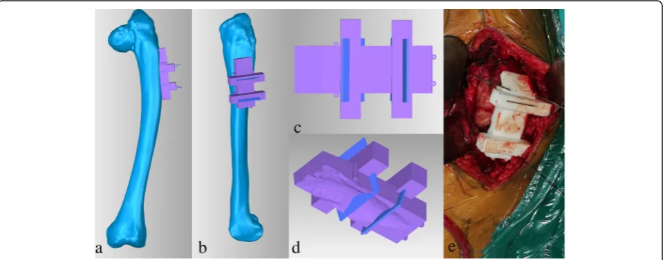 Fig. 2 3D computer models of the femur (a), 3D designing corrective osteotomy (b), 3D designing implantation of long prosthesis stem (c, d) inpatient 1