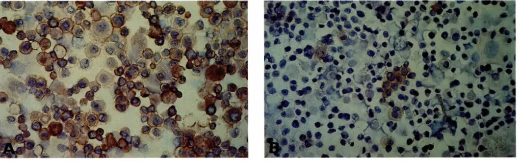 Fig. 4. VLA (B1 integrinlexpressionon H716 cells. fAi u] chain immunoreactivityin a majority of the tumor cells
