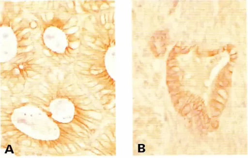 Fig. 6. E-cadherin immunoreactivityon colon adenomacarcinoma.and colon(AI Intenseexpressionon rhe lateralcell bordersof columnarcells in a tubular adenoma.(8) Focal expressionon colon carcinoma cells,invadingthe muscularispropria (indirect immunoperoxidase;x250).