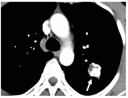 Fig.2.1. This picture shows the Low Dose Chest CT 