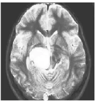 Fig. 3. Preprocessed image using Histogram 