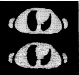Fig. 1. backprojection (bottom). Digital thorax phantom (top), and image reconstructed using filtered 