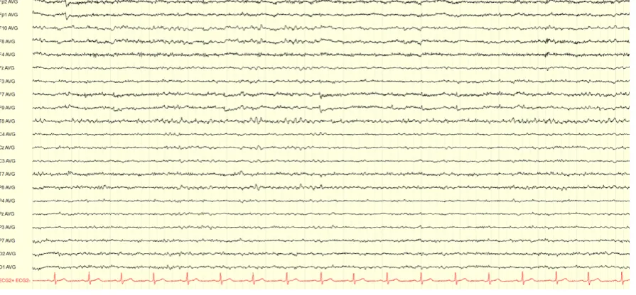 Figure 2.1: EEG recording shown for 15s in the average reference montage. The EEG wasrecorded according to the 10-20 system with additional F9 and F10 electrodes.