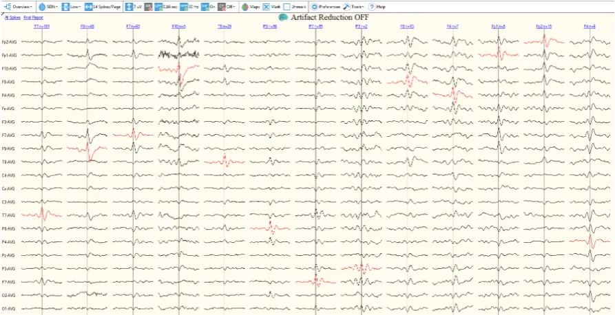 Figure 2.4:Overview of the user interface of Persyst P13 spike review.grouped per electrode location, which are shown in the top row above the EEG segments.Below each electrode group a very short segment of the average waveform of all detectionsThe events arepresent in group are presented in the average reference montage.