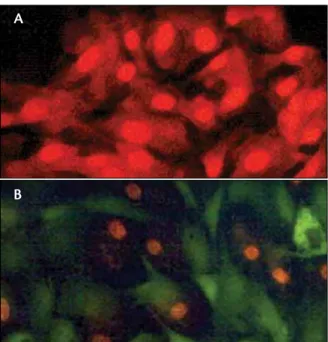 Figure 1.  histological studies of cadaveric tissue suggest  that aLT is more destructive (a) to trabecular cells  com-pared with SLT (B)