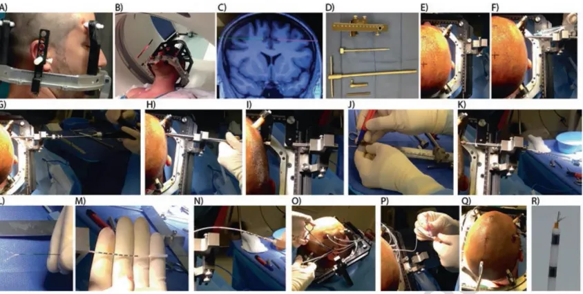 Figure 2.2: Stepwise process of depth electrode insertion (A) Stereotactic frame placement