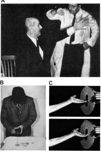 Figure 1-3. Examples of patients with sensorimotor deficits due to parietal injury. (A) A patient with a 