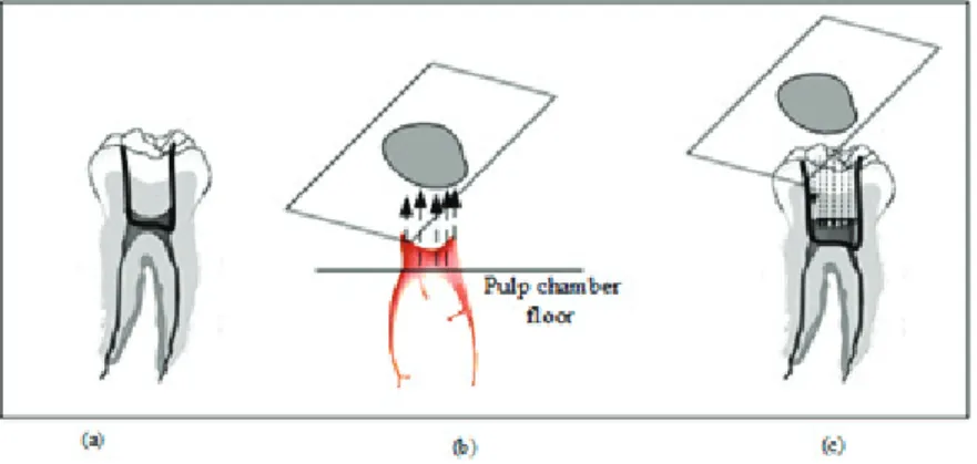 Figure 4.1: Virtual optimal template creation(a) pulp chamber location (b) projection from pulp chamber (c) removal of tooth mass for projected area